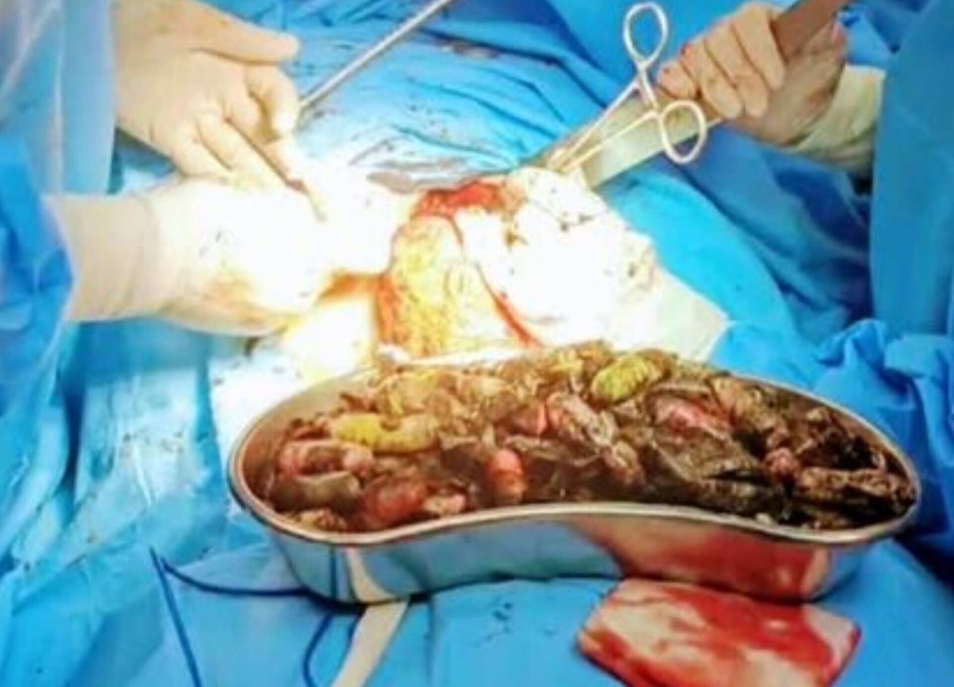 خروج ۹۰ بسته مواد مخدر از معده و روده یک مرد میانسال